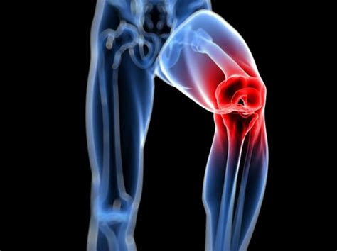 Knee Replacement Surgery What Is Involved Canberra
