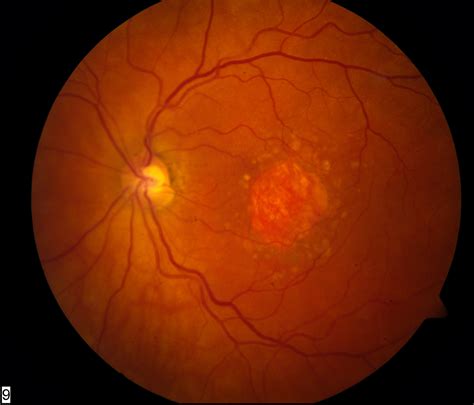 Age-related Macular Degeneration. Causes, symptoms, treatment Age-related Macular Degeneration