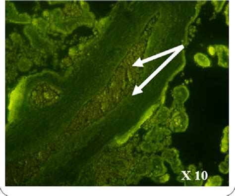 Pec Severe Uptake Reduced Fluorescein By Erythrocytes White Arrows