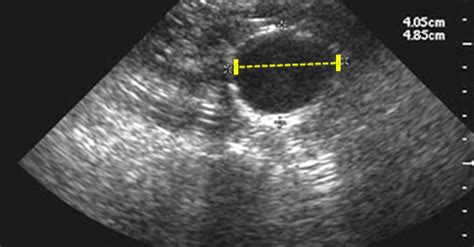 Aneurisma de aorta abdominal, es una dilatación localizada de la aorta abdominal cuando el diámetro es más grande que 3 cm o 50% más grande de lo normal. Screening para Aneurisma de Aorta Abdominal - CardioPapers