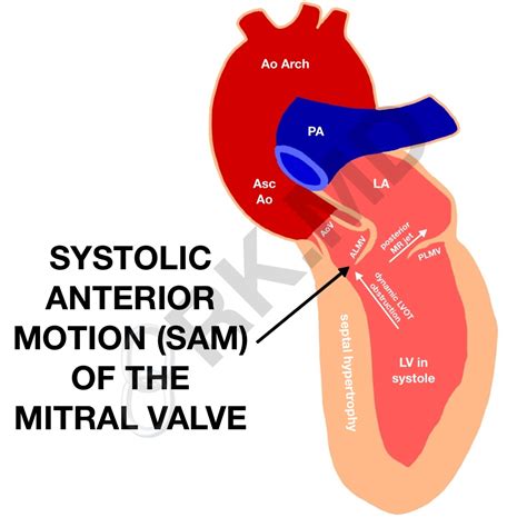 Systolic Anterior Motion Sam Of The Mitral Valve Left Ventricular