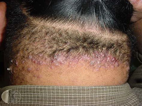 14 Images 4 Hairs In One Follicle
