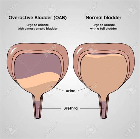 Overactive Bladder Urologic Institute