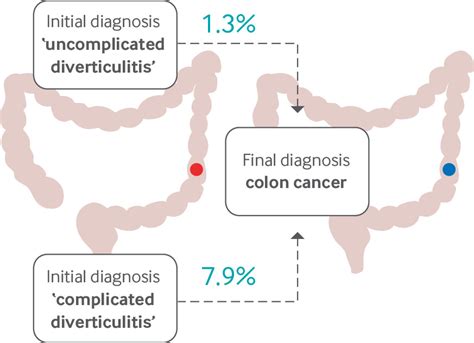Management Of Colonic Diverticulitis The Bmj