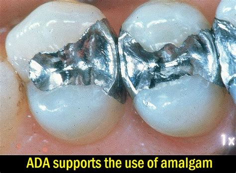 Dental amalgam safety has been debated since the use of this dental material began over 150 years ago, and much of the debate has centered on the mercury in these fillings. DENTAL NEWS: ADA supports the use of amalgam - Ovi Dental