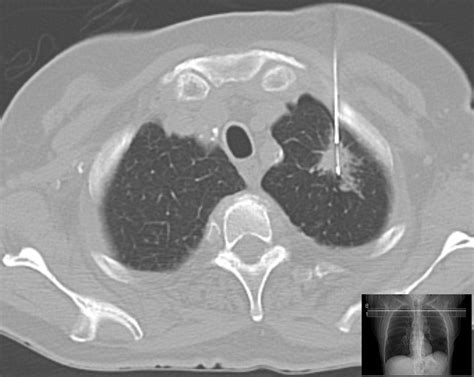 Lung Biopsy Wikipedia