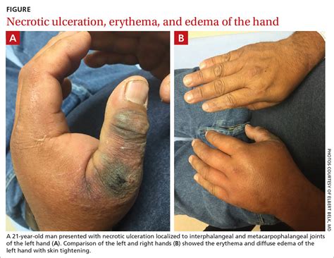 Hand Ulceration MDedge Family Medicine