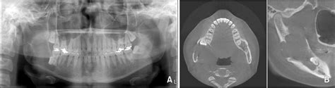 Figure 1 From Conservative Treatment Using Marsupialization For Cysts