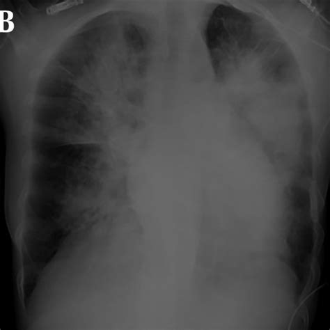 Chest Radiographs Obtained Daily A And B Bilateral Butterfly Shaped