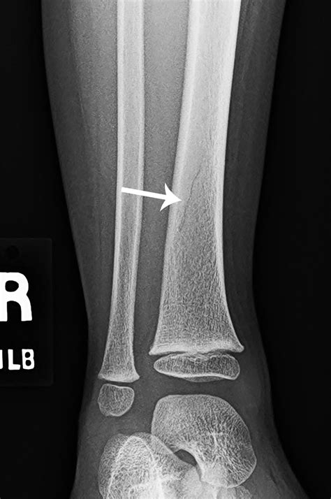 It's tough being a kid: Toddler's fracture | Radiology Key