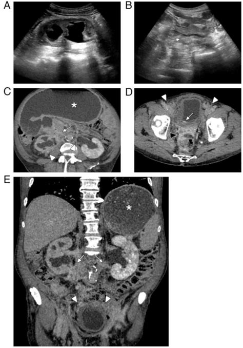 Urothelial Carcinoma Masquerading As Retroperitoneal Fibrosis A Case