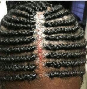 Why Tight Braids Cause Bumps Nathairdiva Resources