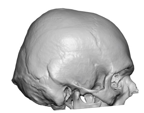 Male Back Of Head Flattening With Occipital Knob D Ct Scan Side View