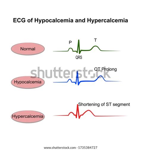 78 Hypercalcemia Images Stock Photos And Vectors Shutterstock