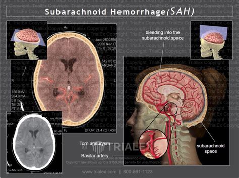 Subarachnoid Hemorrhage Sah Sagittal View Trial Exhibits Inc