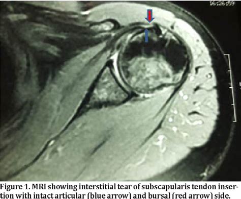 Figure 4 From Interstitial Tear Of The Subscapularis Tendon