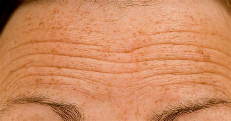 Why Mens Forehead Wrinkles Are Worse And How To Treat The Problem