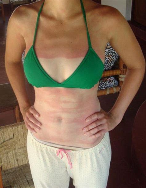 This Woman Ended Up With A More Stripey Look After Failing To Apply Her Sunblock Bad Sunburn
