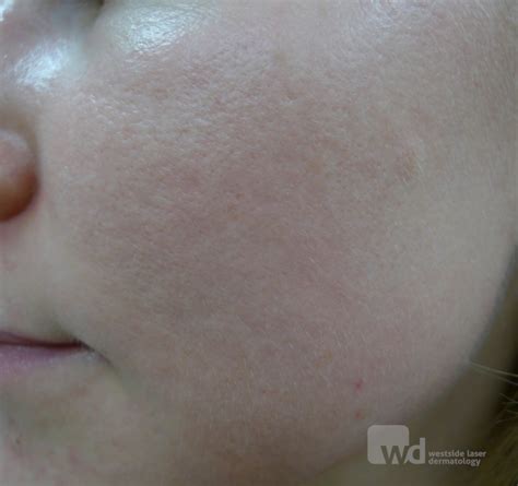 Acd A Z Of Skin Acne Scars Acne Scarring