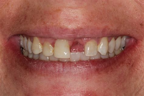 Palmetto Dental Associates — Dental Implants