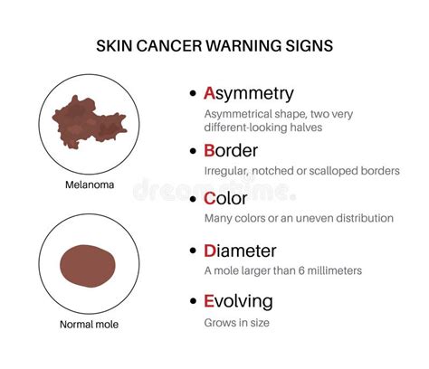Melanoma Warning Signs Stock Vector Illustration Of Tissue 274704490