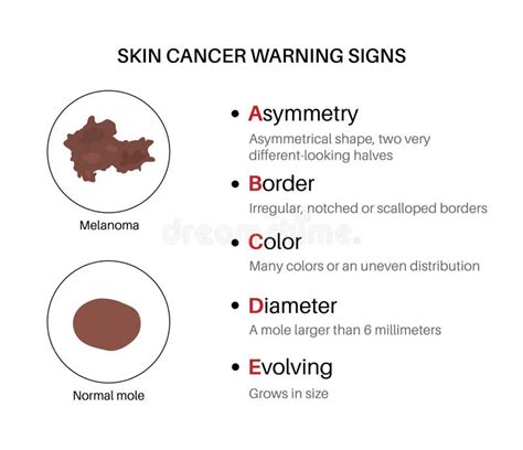 Melanoma Warning Signs Stock Vector Illustration Of Tissue