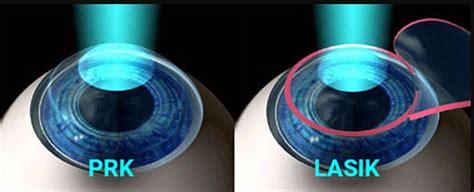 What Is Prk Photorefractive Keratectomy Millennium Laser Eye Centers