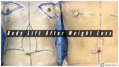 Body Lift After Weight Loss How A Body Lift Is Done Youtube
