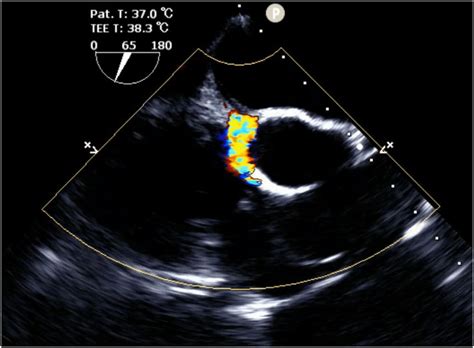 Paravalvular Leakage Confirmed By Transesophageal Echocardiography