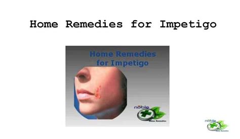 Home Remedies For Impetigo With Causes And Symptoms