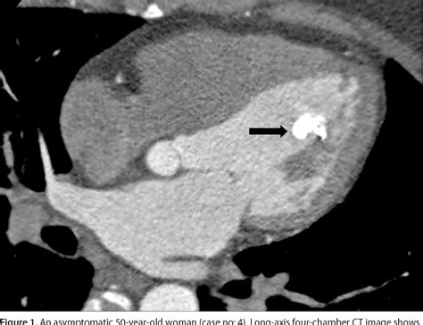 Figure 2 From Cardiac Calcified Amorphous Tumors Ct And Mri Findings