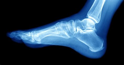 Ankle Sprain Vs Fracture How Are They Different And What