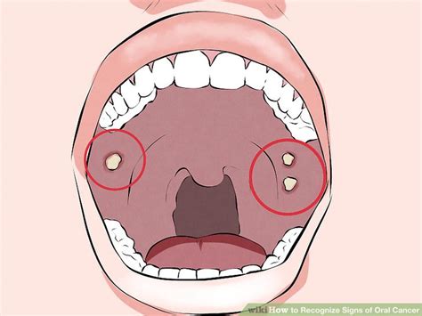 How To Recognize Signs Of Oral Cancer 11 Steps With Pictures