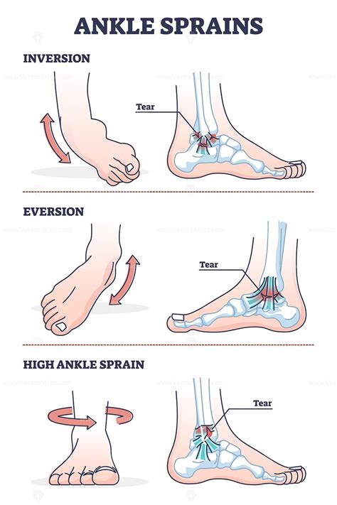 Ankle Sprains Situations With Inversion And Eversion Injury Outline