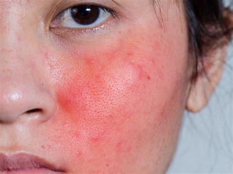 5 Different Types Of Skin Blemishes On The Face And Its Treatments