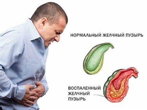 Хронический холецистит симптомы и диета Признаки острого холецистита: симптомы, первая помощь – ЭЛ Клиника Признаки острого холецистита: симптомы, первая помощь – ЭЛ Клиника Хронический холецистит симптомы и диета