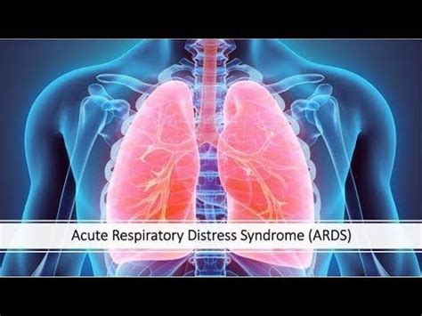 Acute respiratory distress syndrome causes fluid to leak into your lungs, keeping oxygen from getting to your organs. Yourmedicadvisor