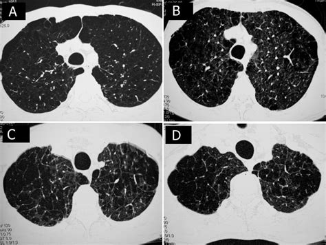 High Resolution Computed Tomography And Chronic Obstructive Pulmonary