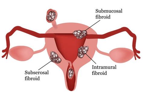Uterine Fibroids Understanding Fibroids And Your Treatment Options