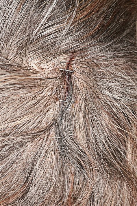 Stapled Scalp Laceration Stock Image C0402160 Science Photo Library