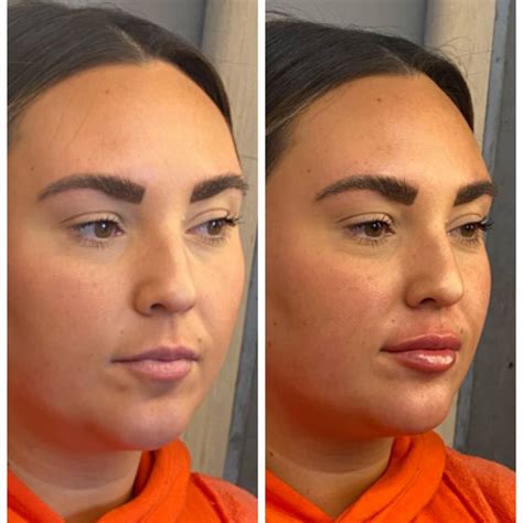 Lip Filler Columbus Oh Boss Gal Beauty Bar