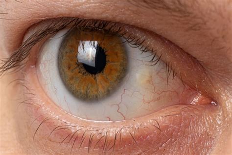 Pinguecula Yellow Bump On Eyeball Diagnosis Causes And Treatment