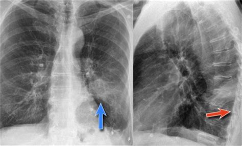 Atelectasis Chest X Ray