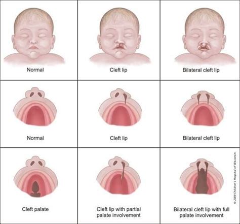 Cleft Awareness How Do You Do It Cleft Lip And Palate Pediatric