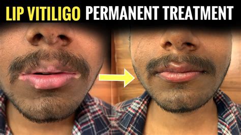 Lip Vitiligo Treatment Organic And Maintenance Free Treatment For White
