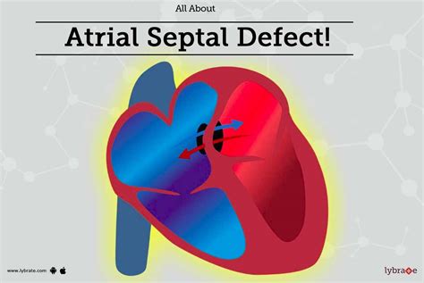 All About Atrial Septal Defect By Dr Gaurav Agrawal Pediatric
