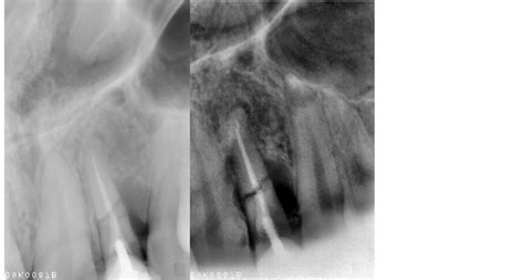 Alveolar Ridge Preservation Of An Extraction Socket Of Fractured
