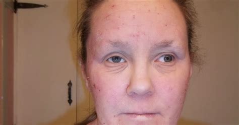 Stopping Topical Steroids 22 Months And Pictures