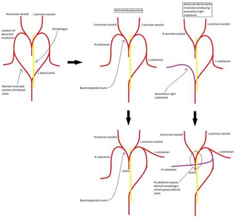 Subclavian Artery Anatomy Branches Mnemonic Clinical Points Learn
