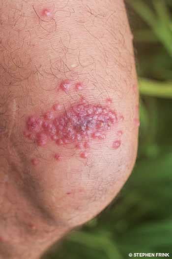 Ask The Experts Knee Irritated And Covered In Red Bumps After Diving